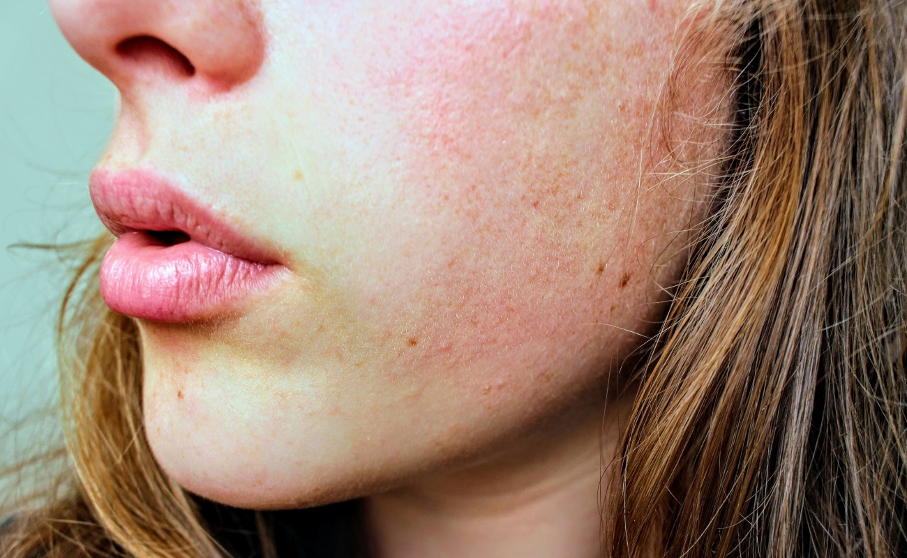 Pelik Kenapa Kulit Kering? Ini Antara Sebabnya