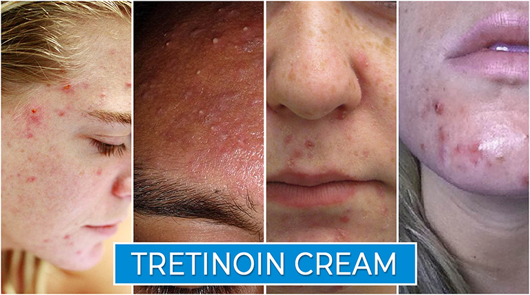 Tretinoin-Cream