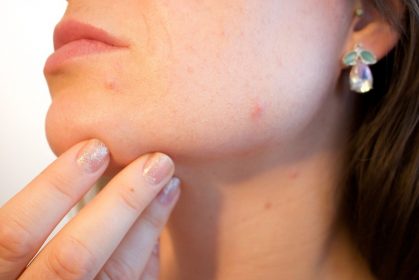Causes & Ways to Reduce Acne
