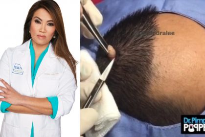 Dr Sandra Lee Berjaya Keluarkan ‘Bawang Putih’ Dari Kulit Kepala Pesakit