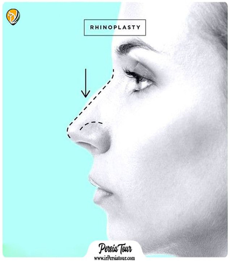 nose-job-surgery
