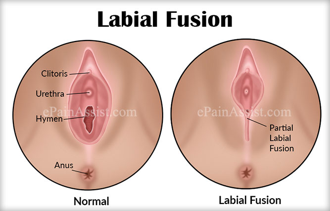 labial-fusion