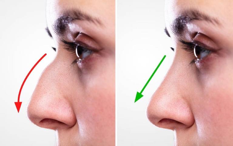 Rhinoplasty-Before-and-After