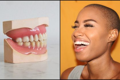 veneer gigi