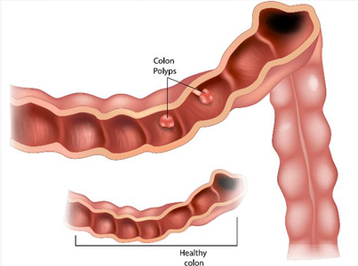 health-articles-orang-muda-pun-boleh-kena-kanser-kolon-banner-2 health-articles-orang-muda-pun-boleh-kena-kanser-kolon