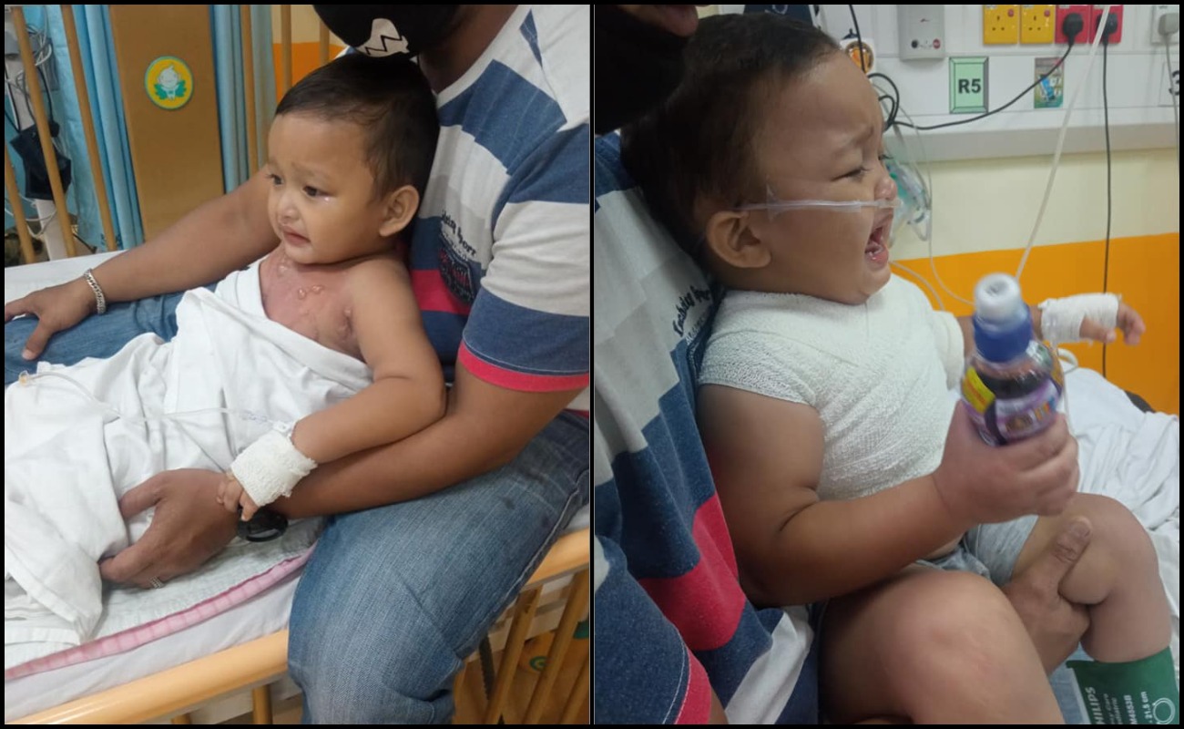 Ibu Trauma Selepas Tertumpahkan Sup Panas, Anak Melecur Tahap 2