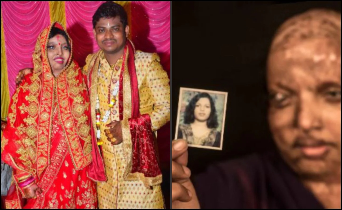 Mangsa Serangan Asid Pramodini Akhirnya Bertemu Jodoh