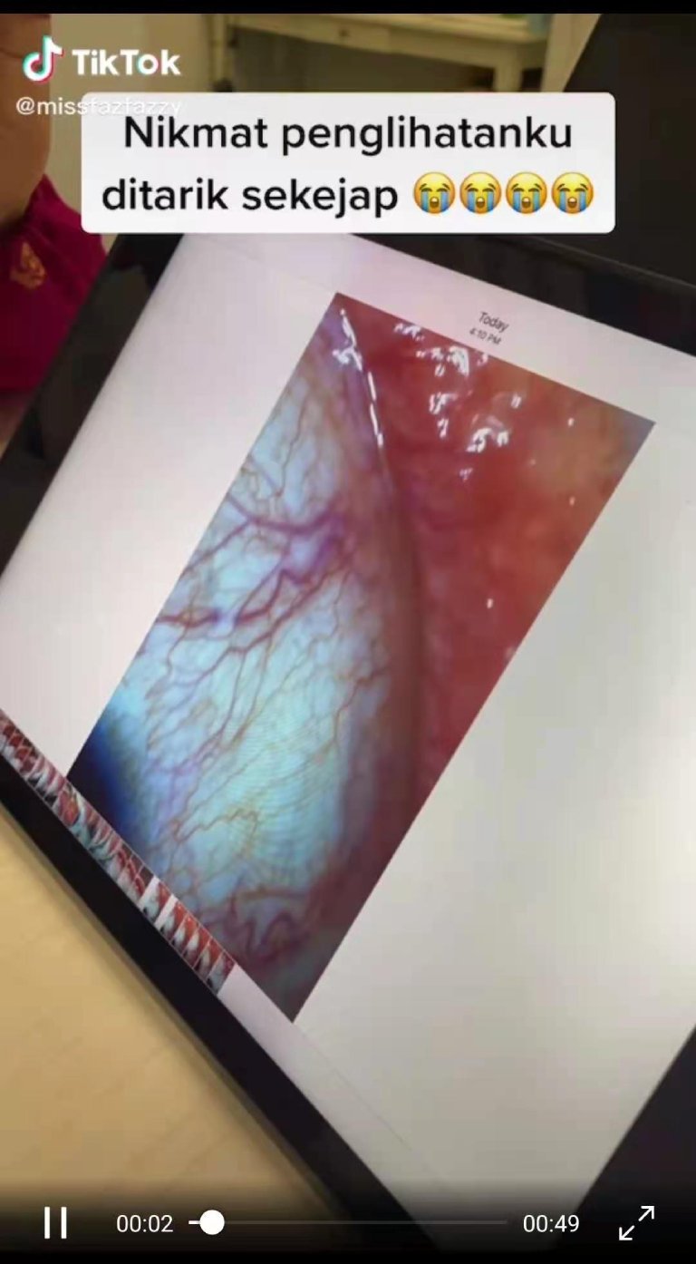 missfazfazzy akibat pemakaian contact lens