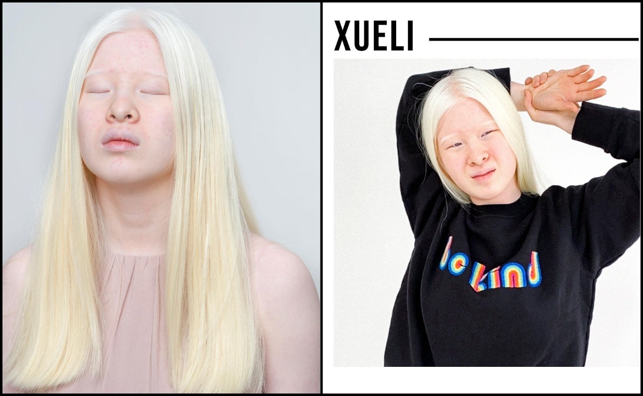 Albino Jadi Pemangkin Semangat, Xueli Pernah Dibuang Keluarga Ketika Kecil