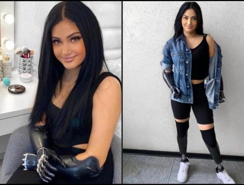 Beyza Dogan Kehilangan Kaki & Tangan Akibat Kegagalan Buah Pinggang