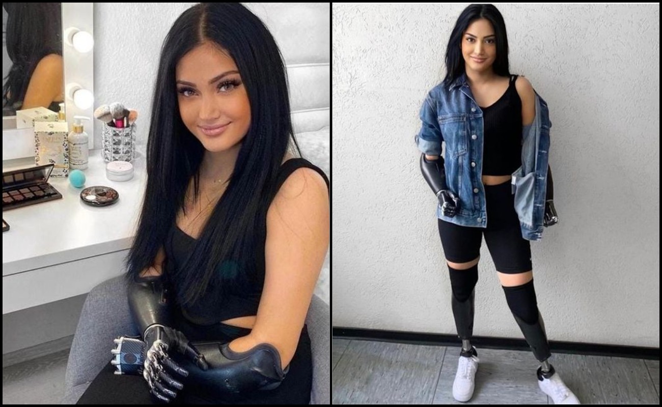 Beyza Dogan Kehilangan Kaki & Tangan Akibat Kegagalan Buah Pinggang