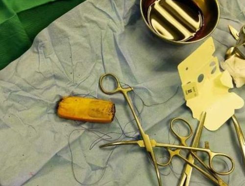 Malu Nak Mengaku Telan Telefon Bimbit, Lelaki Tunggu 6 Bulan Sebelum Jumpa Doktor