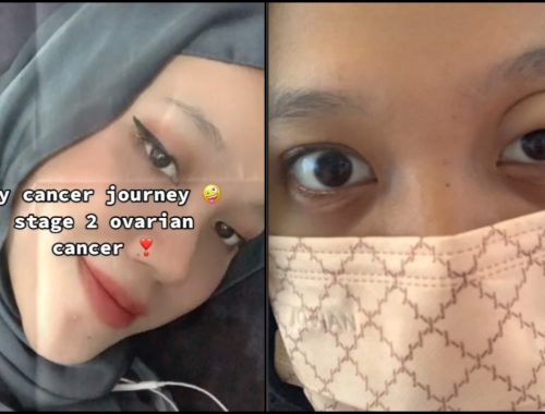 Disangka Mengandung Kerana Buncit, Rupanya Kanser Ovari Tahap Dua