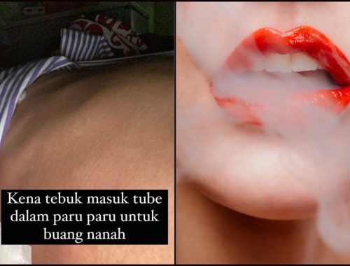 Paru-Paru Ditebuk Gara-Gara Kongsi Vape!