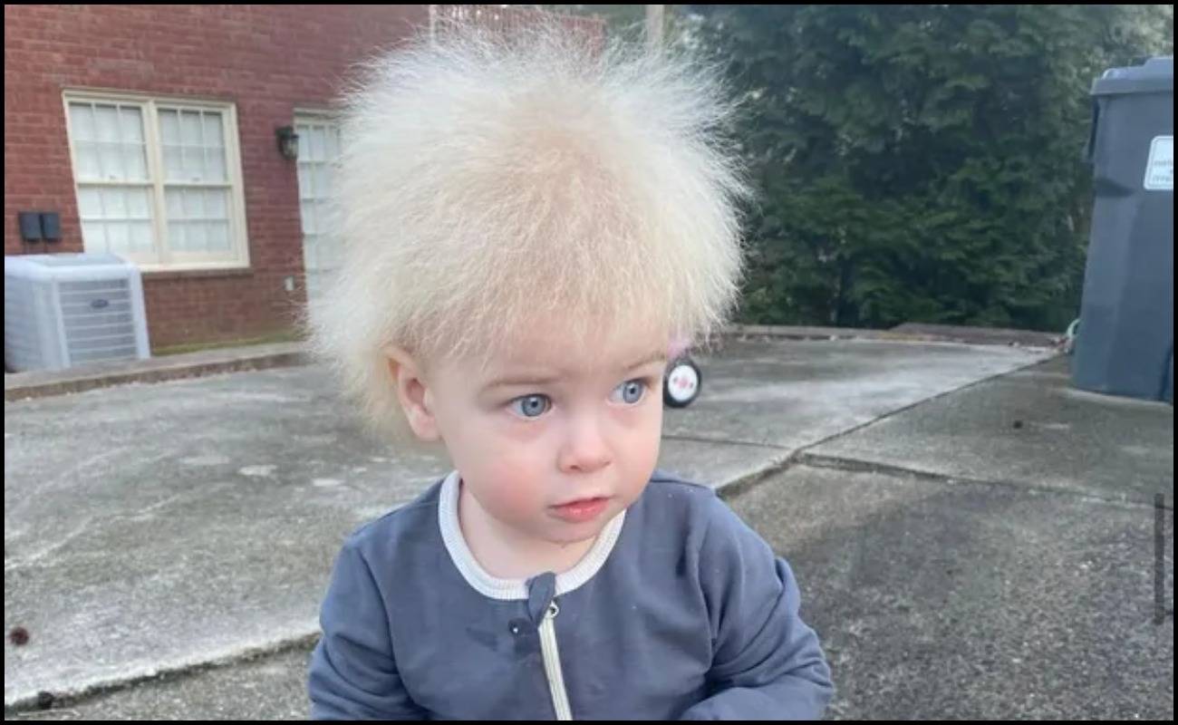 Pelik Tapi Benar! Bayi 10 Tahun Hidap ‘Uncombable Hair Syndrome (UHS)’