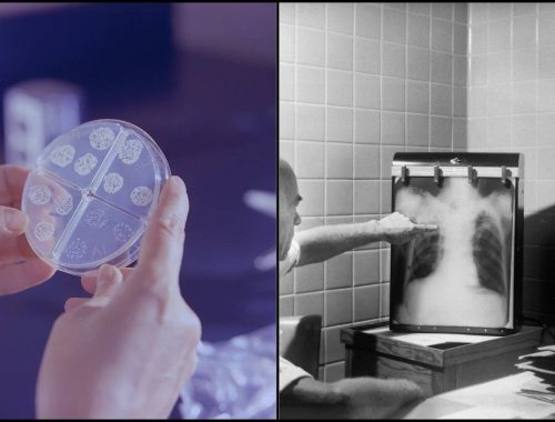 Tiba-Tiba Doktor Cakap Anda Hidap Tuberculosis, Jangan Sampai Memudaratkan!