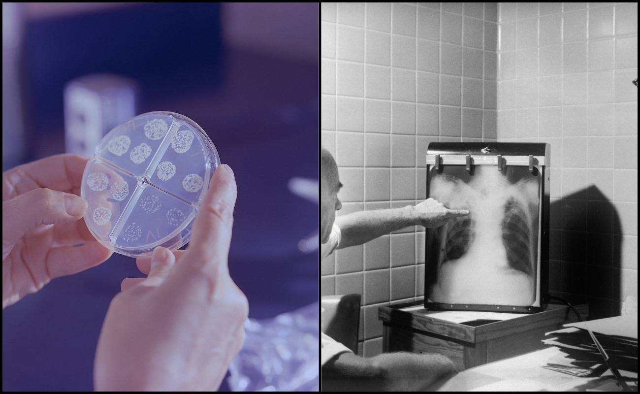 Tiba-Tiba Doktor Cakap Anda Hidap Tuberculosis, Jangan Sampai Memudaratkan!