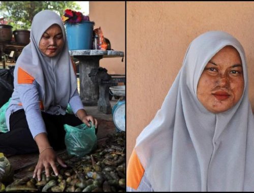 Wajah ‘Cacat’ Gara-Gara Bapa Kandung Simbah Asid, Gadis Teringin Pembedahan Plastik