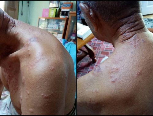 Dicucuk Dos Penggalak Tanpa Izin, Badan Warga Emas Gatal-Gatal Sampai Bernanah