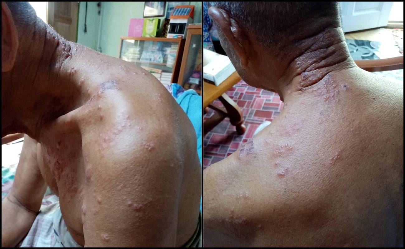 Dicucuk Dos Penggalak Tanpa Izin, Badan Warga Emas Gatal-Gatal Sampai Bernanah