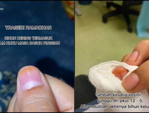 Serpihan Bihun Kering Punya Pasal, Gadis Terpaksa Dapatkan Pergi Hospital!