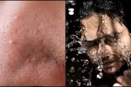 Malulah Ada Biji-Biji Halus Di Hidung, Kurangkan Tiny Bump 5 Dengan Ikut Cara Ini!