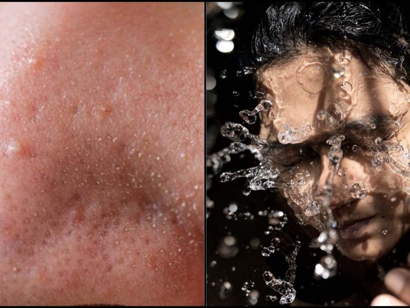 Malulah Ada Biji-Biji Halus Di Hidung, Kurangkan Tiny Bump 5 Dengan Ikut Cara Ini!