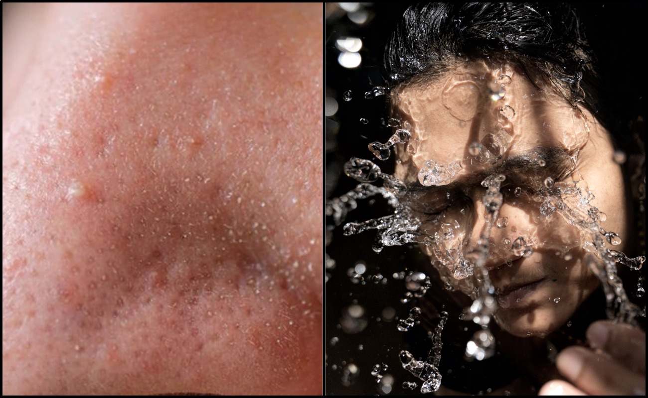 Malulah Ada Biji-Biji Halus Di Hidung, Kurangkan Tiny Bump 5 Dengan Ikut Cara Ini!