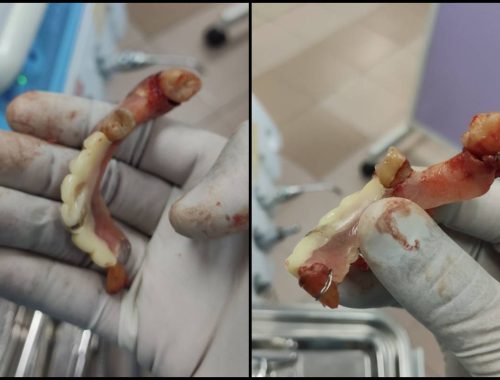 Pasang Gigi Palsu RM500 Di Hotel, Doktor Mengucap Panjang!