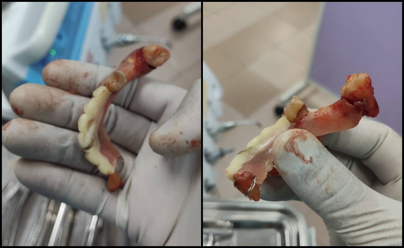 Pasang Gigi Palsu RM500 Di Hotel, Doktor Mengucap Panjang!